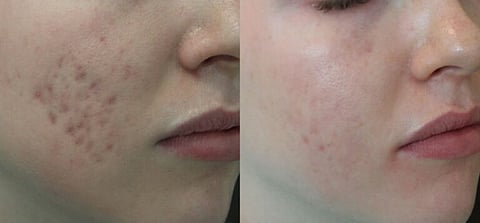 RF microneedling before and after: what are the benefits?