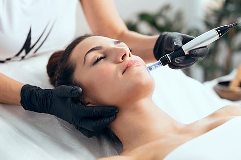 A microneedling treatment session