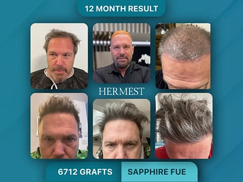 Hair transplant before-and-after results for a Sapphire FUE procedure.