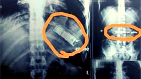 6 महिने मोबाईल पोटात घेवून फिरत होता व्यक्ती; एक्स-रे बघून डॉक्टरही चक्रावला