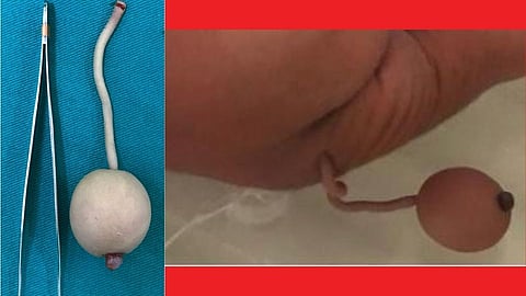 आश्चर्य! ब्राझीलमध्ये शेपटीसह जन्माला आले बाळ!