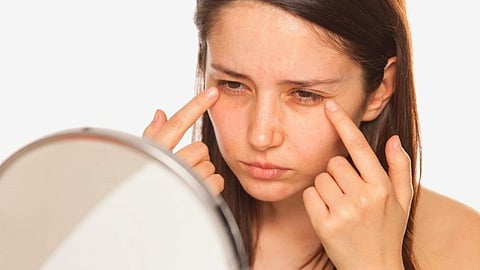 Dark Circles