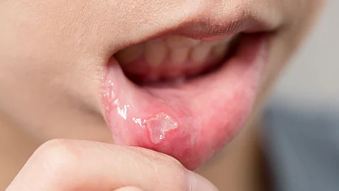 home remedies for mouth ulcer in Marathi