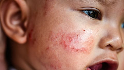 Allergies, Kids health, Child care