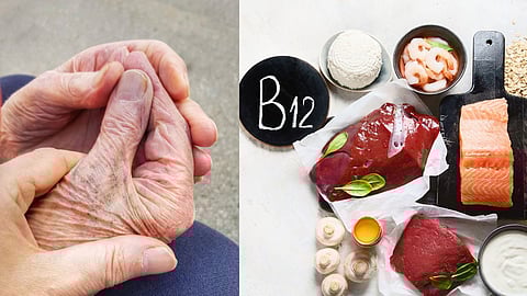 Vitamin B-12 Deficiency