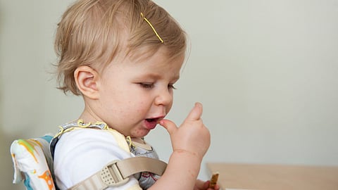 Hand Foot Mouth Disease
