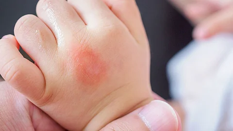 Measles Disease