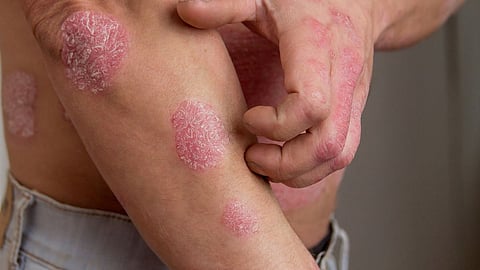 Psoriasis Disease