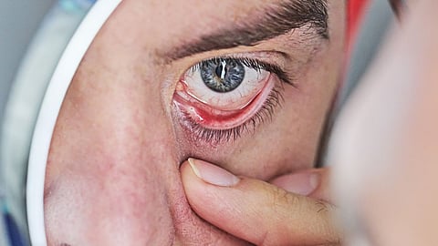 Eye Redness
