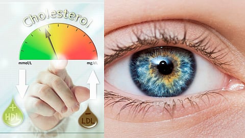 Cholesterol Side Effects