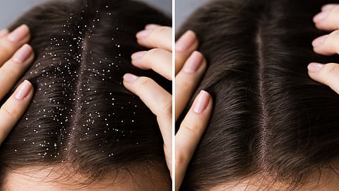 Hair Dandruff