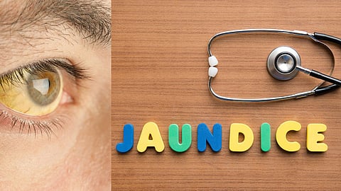 Jaundice Disease