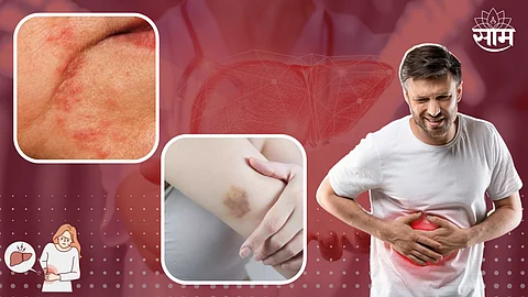 Fatty Liver Symptoms On Skin