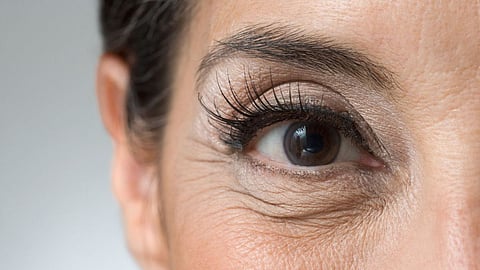 Under Eye Wrinkles Remedies