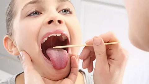 Tonsillitis