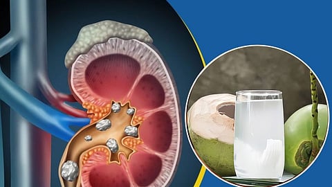 Kidney Stone
