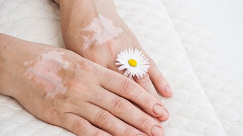 World Vitiligo Day 2023