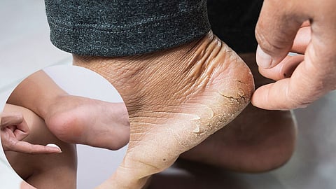Cracked Heels Home Remedies
