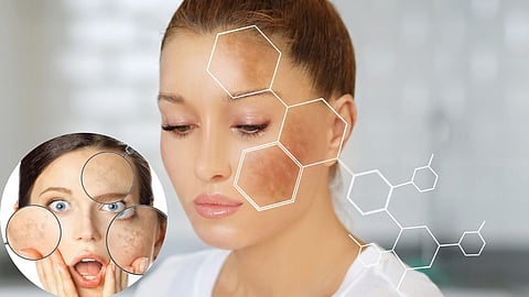 Dark Spots Causes
