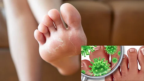 Monsoon Skin Infection