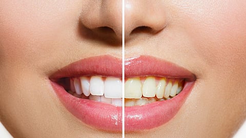Yellow Teeth Whitening Remedy