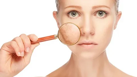 Dark Spots Treatment