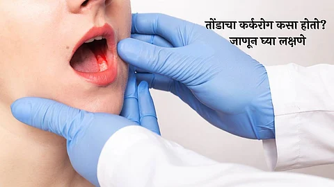 Oral Cancer Symptoms