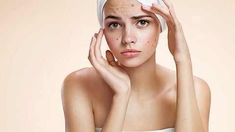 Acne Skin Care