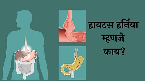 Hiatus Hernias: हायटस हर्निया म्हणजे काय? याची लक्षणे कोणती? उपचार कसा कराल? जाणून घेऊया