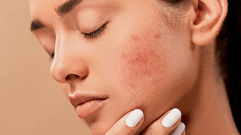 Skin Problems