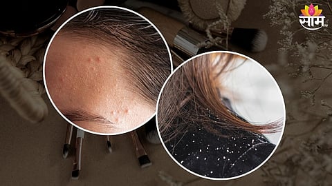 Pimple Free Skin Tips: कपाळावर पिंपल्स वाढतायत? 'या' टिप्स फॉलो करा, चेहऱ्याचे सौंदर्य जपा..