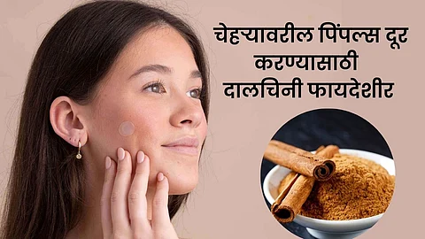 Pimple Free Skin