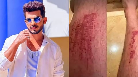 Arjun Bijlani Accident