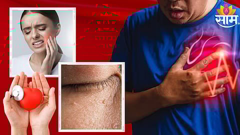 Cholesterol Signs On Face