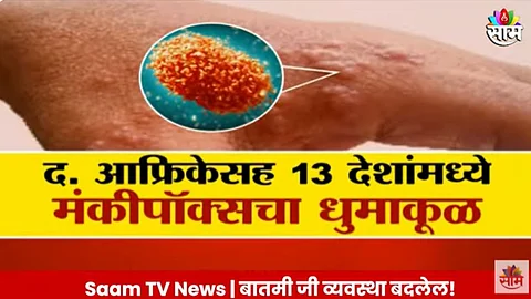 Monkeypox Virus