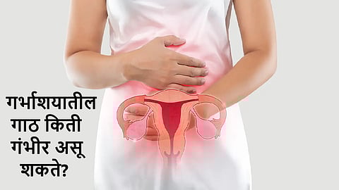 Cyst In Uterus