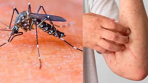 dengue