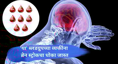 Blood Type and Brain Stroke