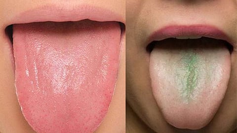 Tongue health