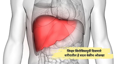 What Is Liver Cirrhosis