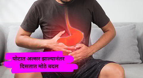 Stomach Ulcer Symptoms