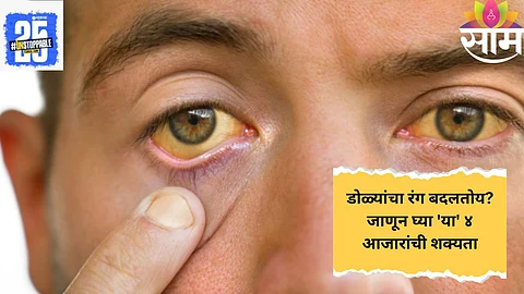 डोळे पिवळे दिसतायेत? मग थकवा नाही तर 'या' ४ गंभीर आजारांचे असू शकतात संकेत