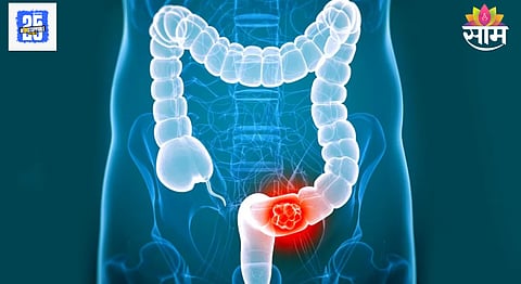 First Stage Colon Cancer