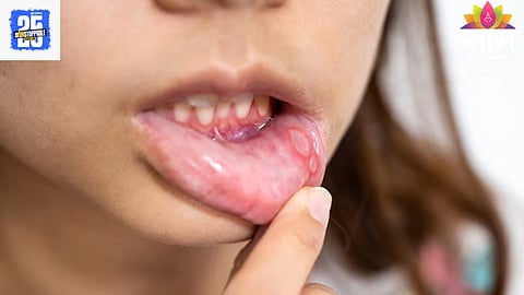 Mouth Ulcers