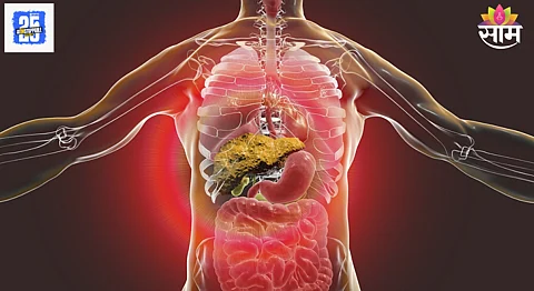 Liver cirrhosis