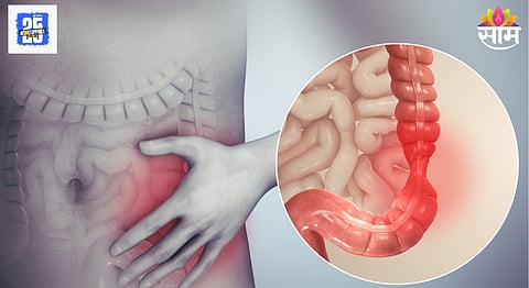 Irritable bowel syndrome
