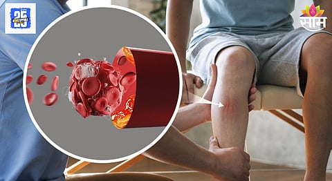 Blockages in arteries
