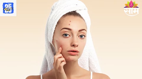 Remedies To Reduce Pimples