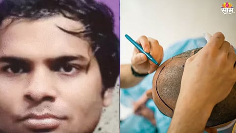 hair transplant