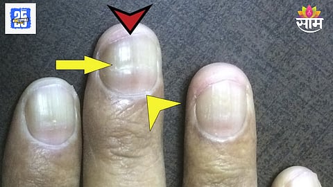 Liver Disease Symptoms